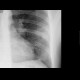 Lung tuberculosis, cavern, endobronchial spread, tree-in-bud: X-ray - Plain radiograph
